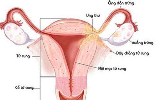 Bệnh Viêm phần phụ có thể gây vô sinh - ảnh 1