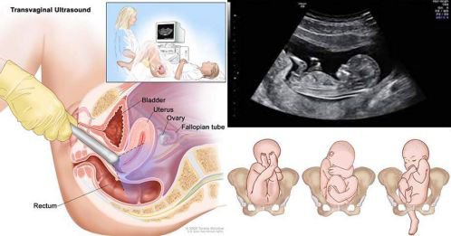 Cổ tử cung ngắn nguy cơ sinh non, sảy thai, chị em cần lưu ý - ảnh 2