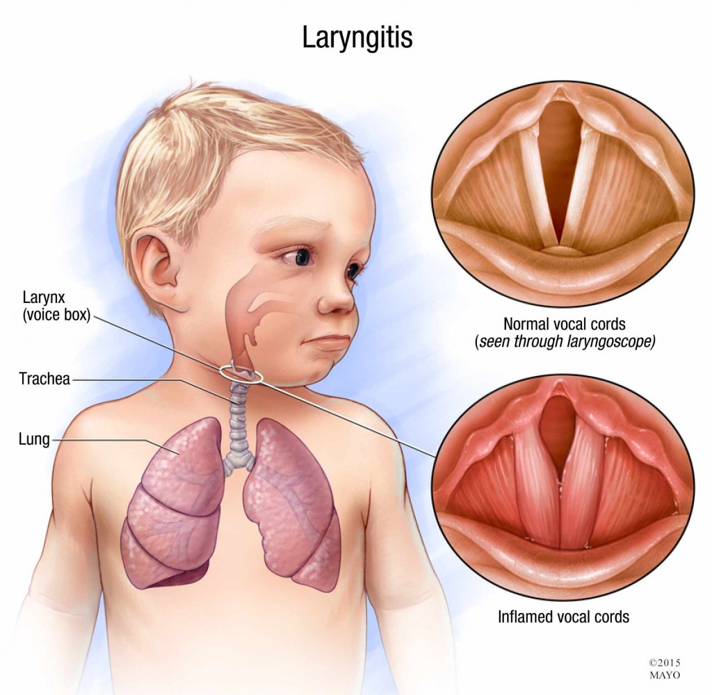 Ảnh 1 của Laryngitis