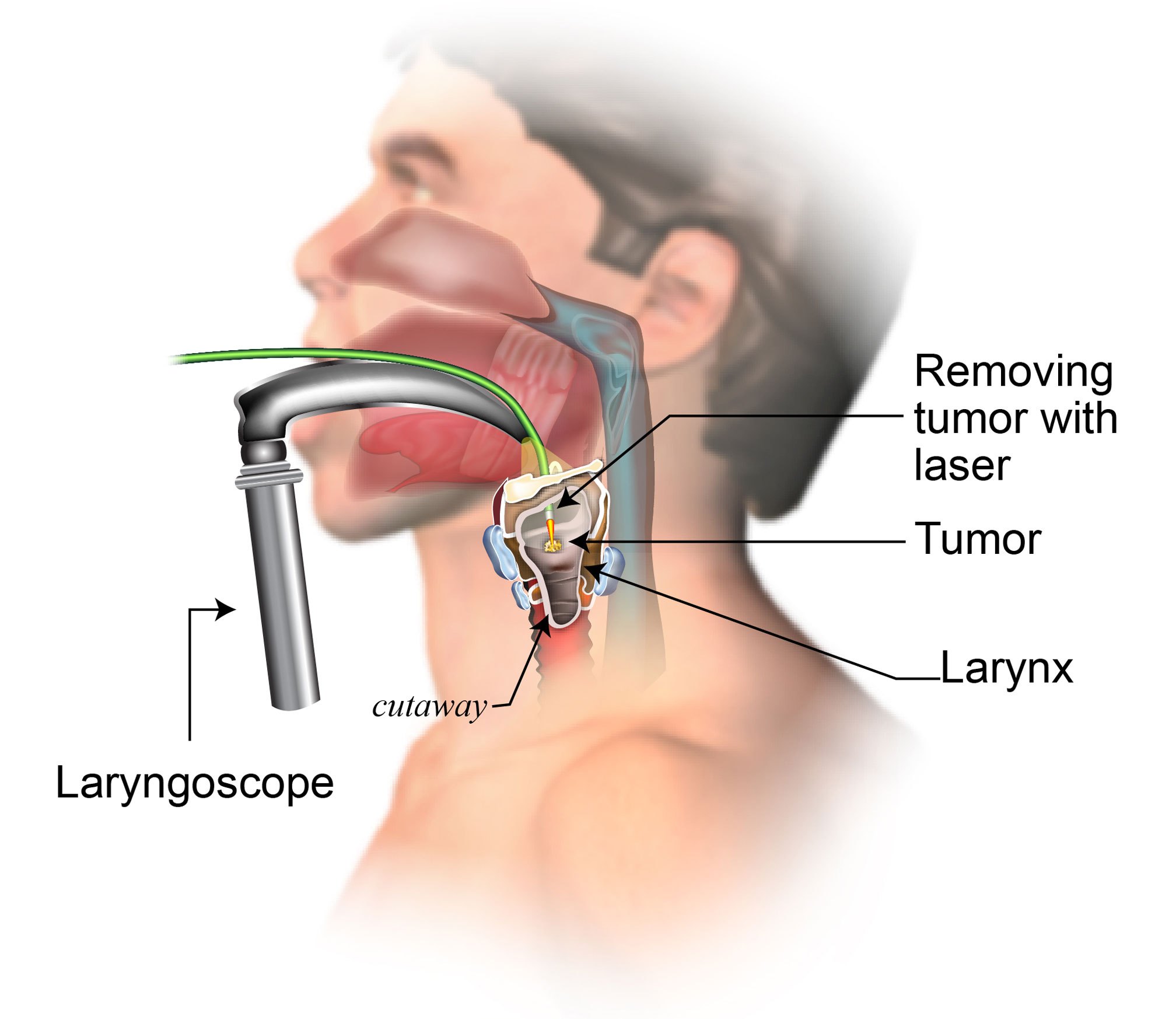 Ảnh 1 của Larynx Cancer