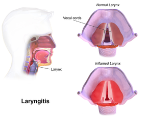 Ảnh 4 của Laryngitis