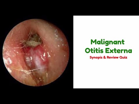 Ảnh 4 của Malignant otitis externa