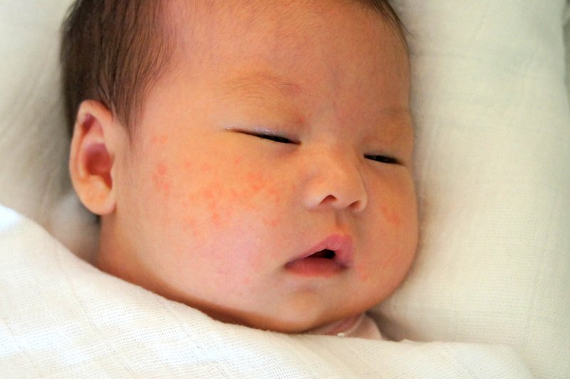 Trẻ sơ sinh khi bị bệnh sởi và Cách Chăm sóc - ảnh 1
