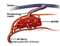 Ảnh 3 của Brain arteriovenous malformation