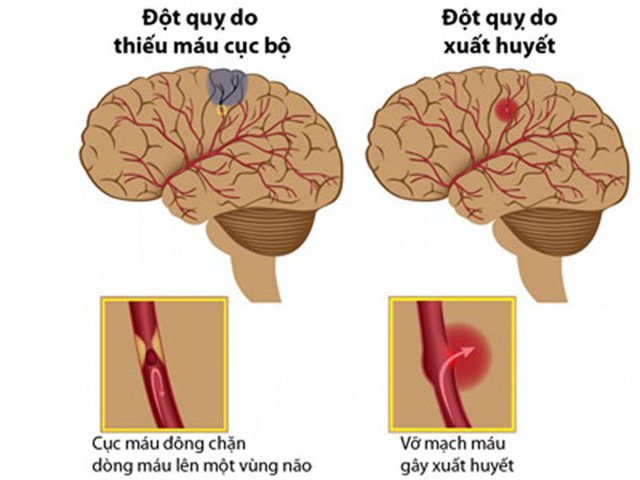 Phương pháp phòng tránh tai biến mạch máu não - ảnh 1