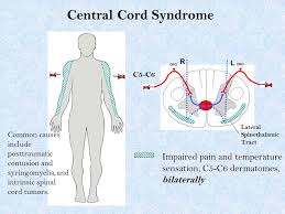Ảnh 3 của Central Cord Syndrome