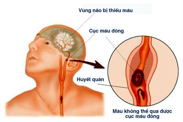 Ảnh 4 của Tắc động mạch tiểu não dưới sau (đột quỵ)