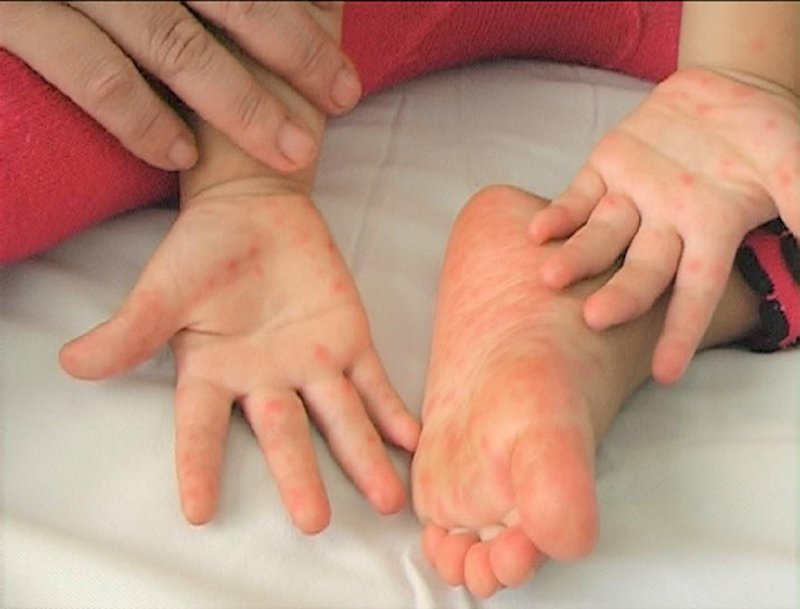 3 dấu hiệu nhận biết bệnh tay chân miệng giai đoạn nặng ở trẻ nhỏ