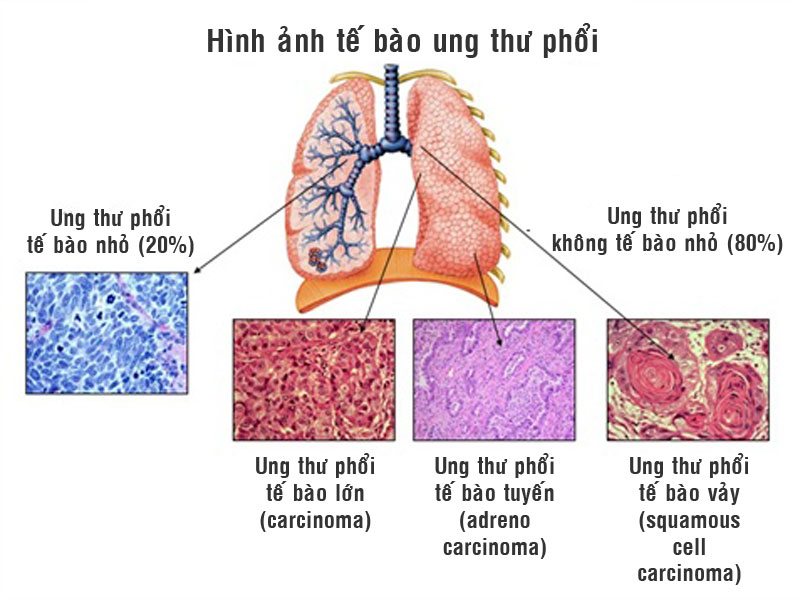 Ảnh 1 của Ung thư phổi tế bào vảy