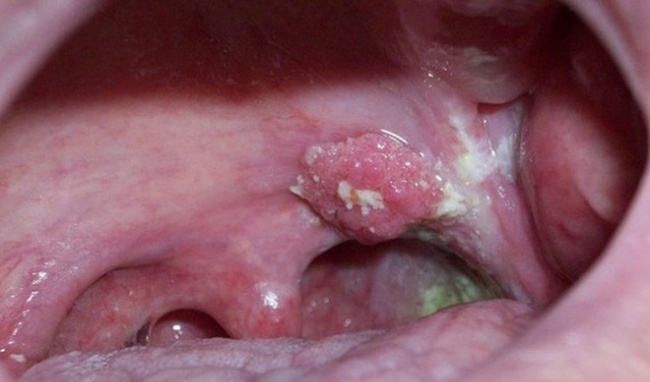Ảnh 1 của Ung thư miệng (Ung thư hầu họng)
