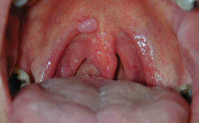 Ảnh 4 của Ung thư miệng (Ung thư hầu họng)