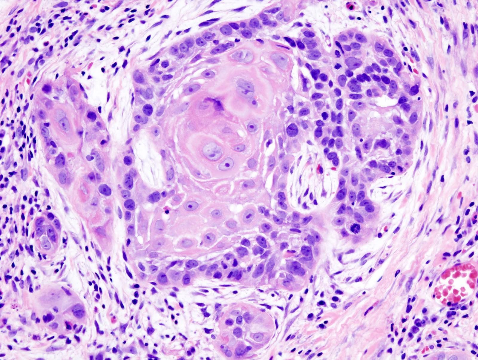 Ảnh 3 của Ung thư phổi tế bào vảy