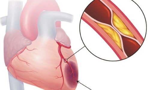 Chụp mạch vành - Trong Chẩn đoán và điều trị bệnh mạch vành