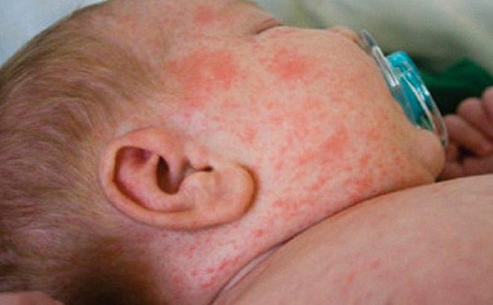 Sốt Virus Bao Lâu Thì Khỏi? Cách Nhanh Chóng Hồi Phục Và Phòng Ngừa Hiệu Quả