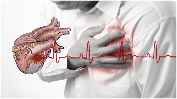 Nhồi máu cơ tim cấp là gì? Nguyên nhân và Triệu chứng nhận biết - ảnh 2