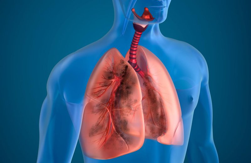 Những xét nghiệm giúp phát hiện bệnh phổi tắc nghẽn mãn tính