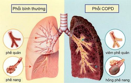Những xét nghiệm giúp phát hiện bệnh phổi tắc nghẽn mãn tính - ảnh 2