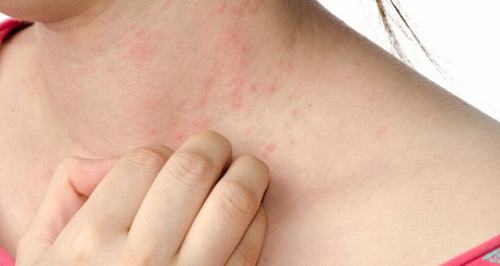 Bệnh Ung Thư Biểu Mô Tế Bào Vảy: Nguyên Nhân, Biến Chứng Và Cách Điều Trị