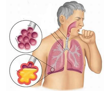 Bệnh Nhiễm trùng đường hô hấp trên: Nguyên nhân, biến chứng và cách điều trị