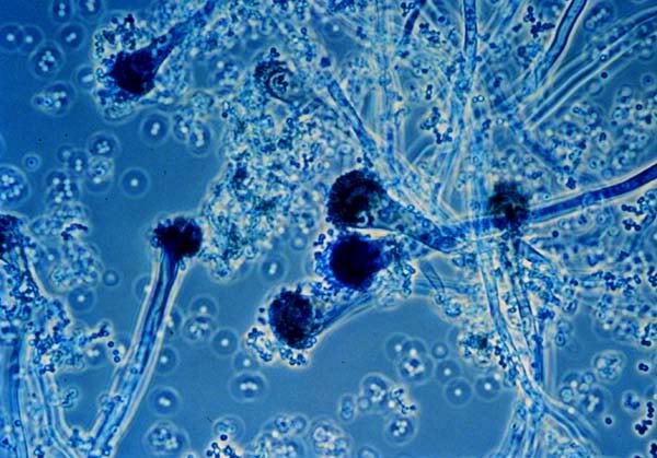 Bệnh Nhiễm trùng nấm aspergillus: Nguyên nhân, biến chứng và cách điều trị