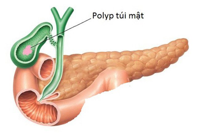 Polyp túi mật là bệnh gì, Triệu chứng và có cần phải điều trị không?