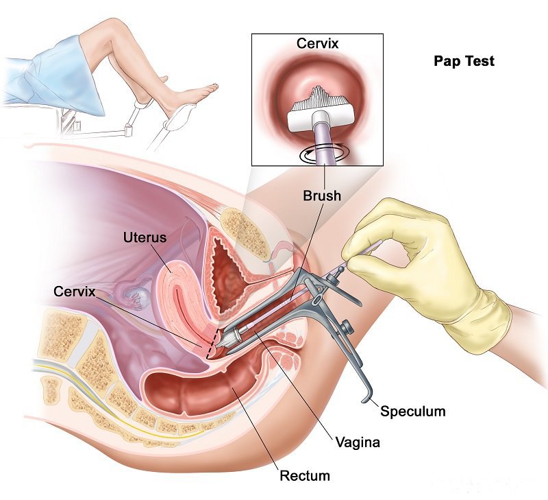 Xét nghiệm Pap - Phương pháp sàng lọc ung thư cổ tử cung - ảnh 1