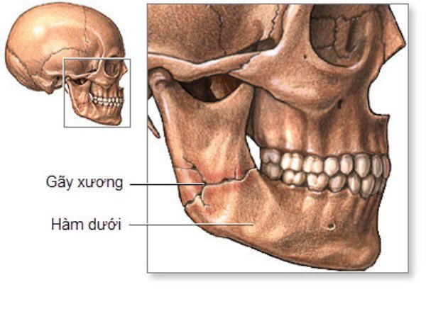 Gãy xương hàm mặt các phương pháp điều trị - ảnh 1