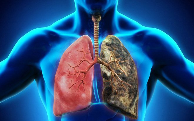 Điều trị ung thư phổi bằng phương pháp xạ trị - ảnh 1