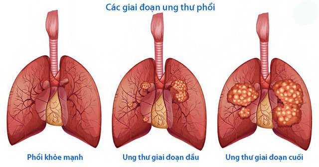 Điều trị ung thư phổi bằng phương pháp xạ trị - ảnh 2
