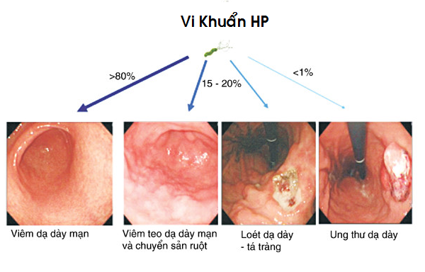 Nhiễm vi khuẩn HP nếu Gắp thức ăn cho nhau - ảnh 2