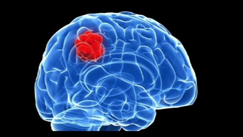 Triệu chứng bệnh u não và cách điều trị