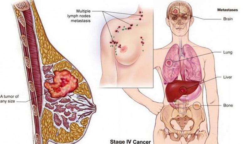 Ung thư di căn có sử dụng liệu pháp miễn dịch tự thân được không? - ảnh 1