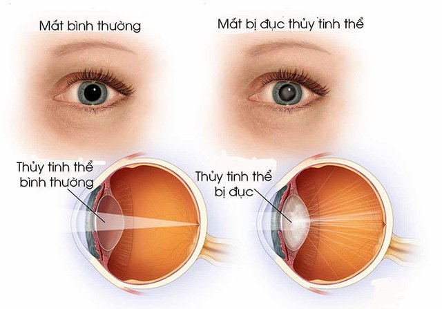 Bệnh đục thủy tinh thể có thể gây mù lòa - Cần phát hiện sớm để điều trị - ảnh 1