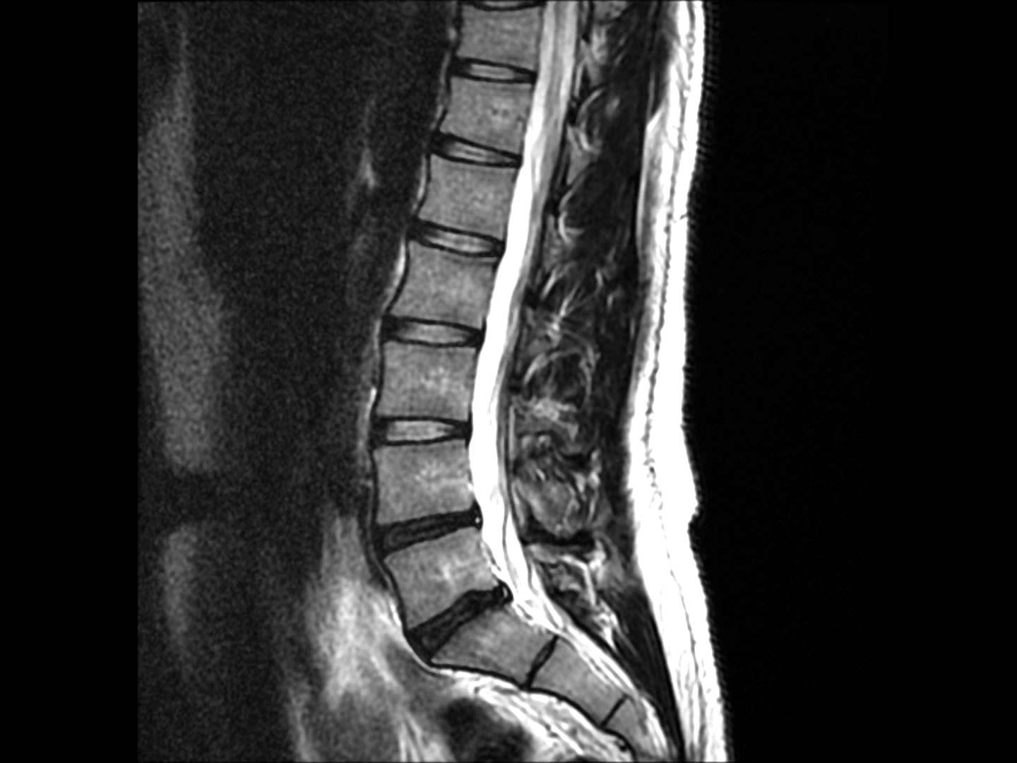 Phẫu thuật điều trị thoát vị đĩa đệm cột sống thắt lưng - ảnh 2