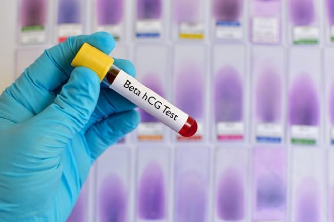 Ý nghĩa xét nghiệm PAPP-A và free beta HCG (Double test)trong sàng lọc dị tật - ảnh 2