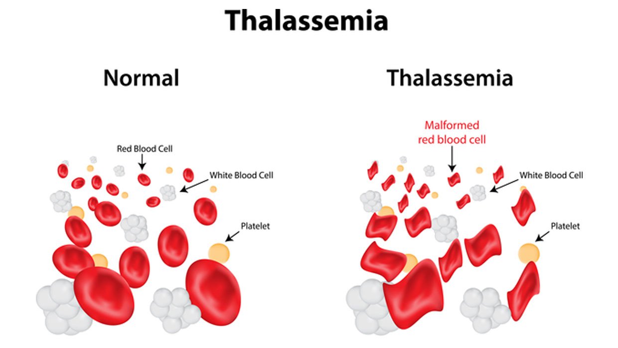 Làm thế nào để phát hiện bệnh thalassemia hay tan máu bẩm sinh ? - ảnh 1