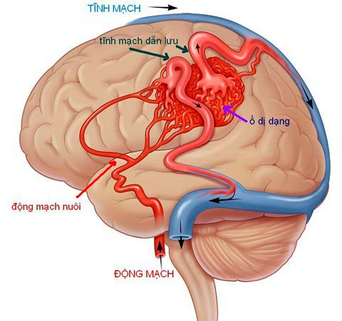 Dị dạng mạch máu não là bệnh gì? Nguyên nhân, triệu chứng và phương pháp điều trị - ảnh 1