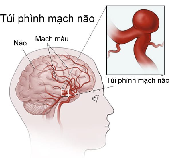 Đột nhiên đau đầu dữ dội: Cảnh giác dị dạng mạch máu não và cách phòng tránh - ảnh 1