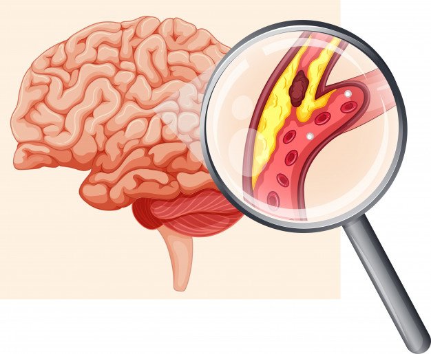 Sự hình thành cục máu đông trong tai biến mạch máu não