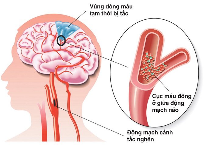 Sự hình thành cục máu đông trong tai biến mạch máu não - ảnh 1