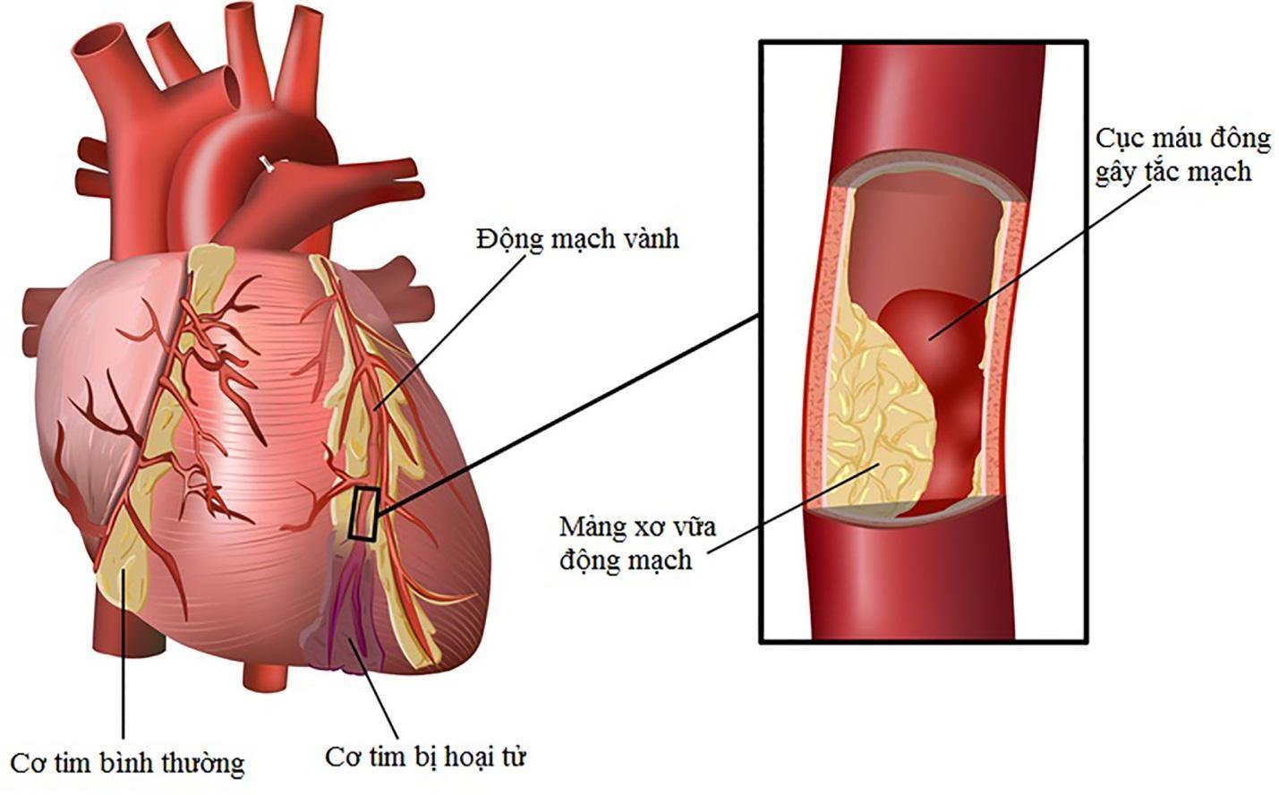 Hẹp mạch vành dễ dẫn đến nhồi máu cơ tim - ảnh 1