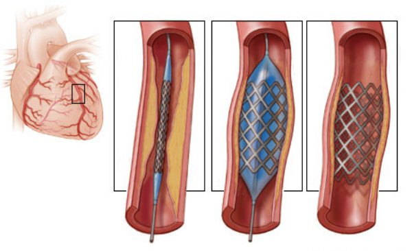 Nong mạch vành và đặt stent: Chỉ định, quy trình thực hiện, biến chứng có thể xảy ra - ảnh 2