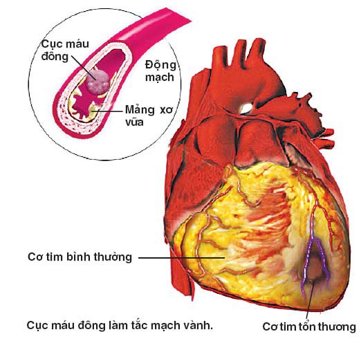 Ưu điểm và nguy cơ khi mổ bắc cầu động mạch chủ - động mạch vành - ảnh 1