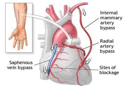 Ưu điểm và nguy cơ khi mổ bắc cầu động mạch chủ - động mạch vành - ảnh 3