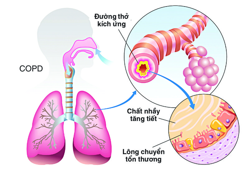 Bệnh phổi tắc nghẽn mãn tính có phải là hen suyễn do hút thuốc lá?