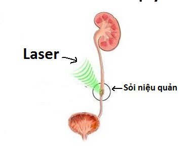Nội soi tán sỏi niệu quản bằng laser:Tán được sỏi cỡ lớn, không tổn thương niệu quản - ảnh 1