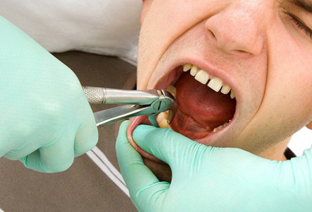 Hướng dẫn Chăm sóc răng miệng sau xạ trị ung thư đầu cổ - ảnh 1