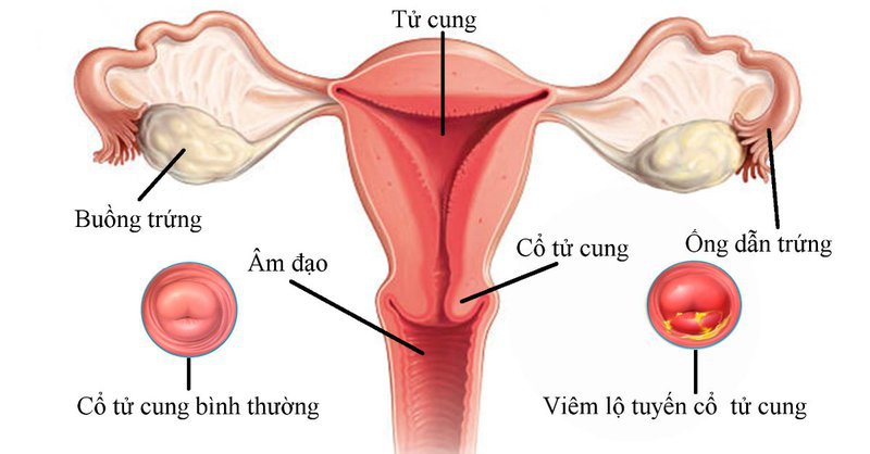 Các bệnh thường gặp ở cổ tử cung - ảnh 1