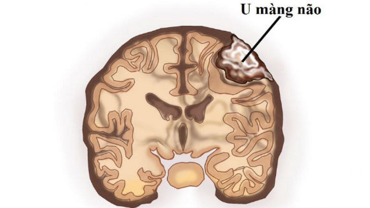 Chẩn đoán u màng não bằng cộng hưởng từ (MRI) - ảnh 1