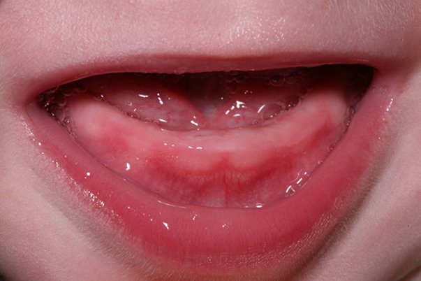 Chậm mọc răng: Nguyên nhân, phòng tránh và Quá trình mọc răng của trẻ - ảnh 1